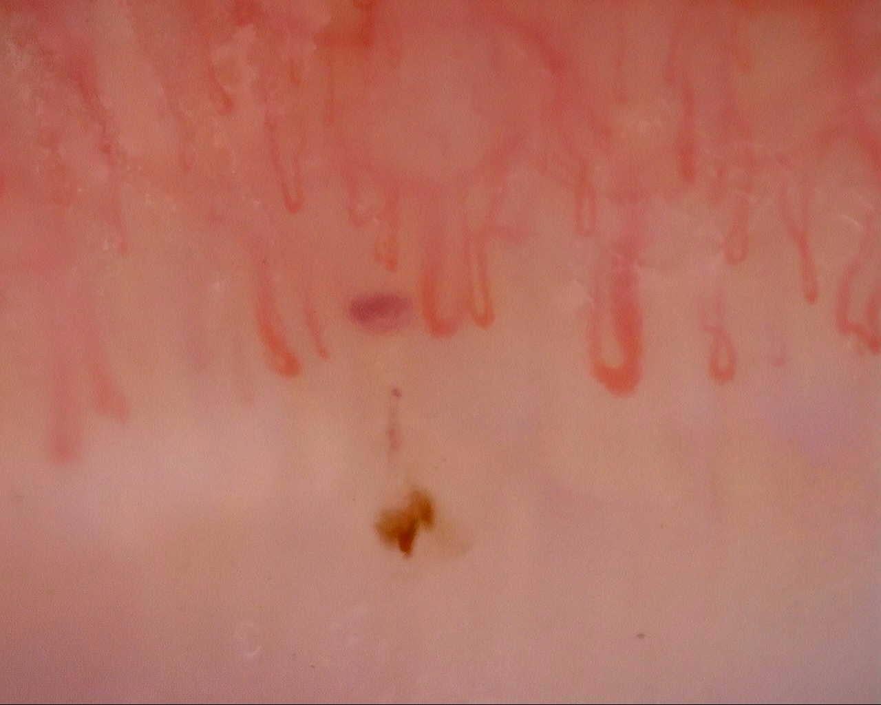 Early pattern with a giant capillary and hemorrhages in a case of MCTD