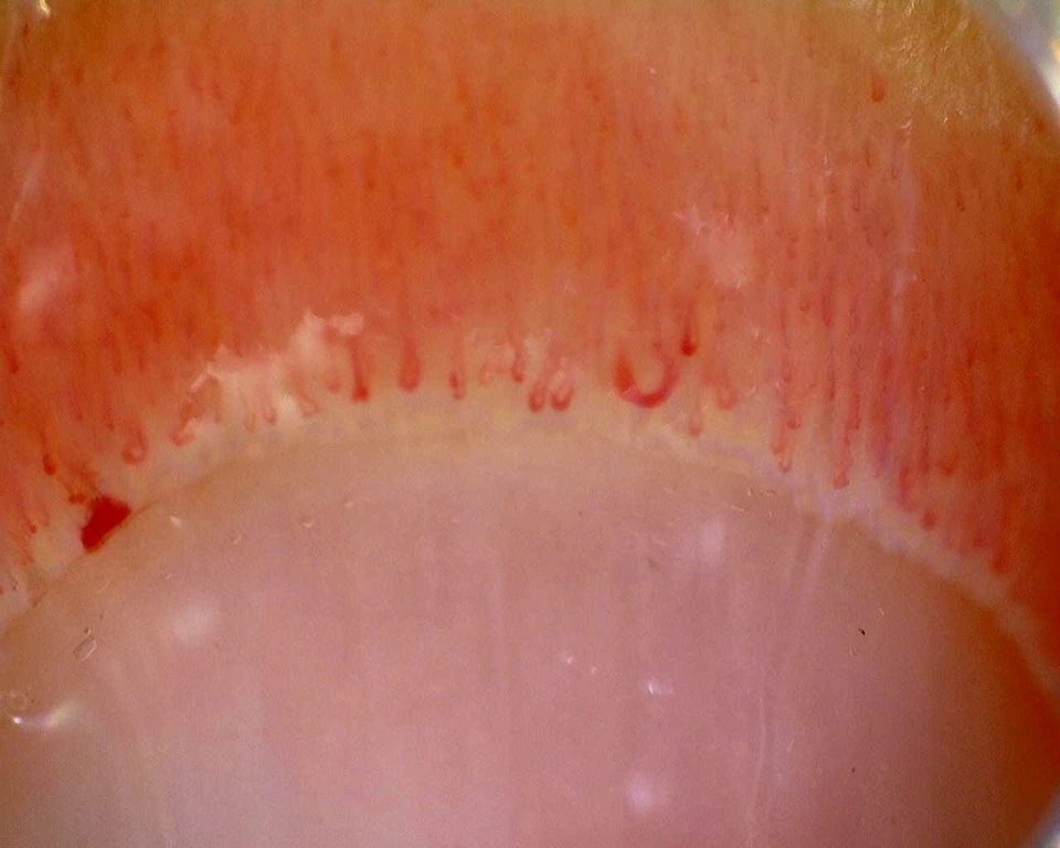 Preview image for Limited Cutaneous Systemic Sclerosis (ACA+) with Active Cutolo Pattern