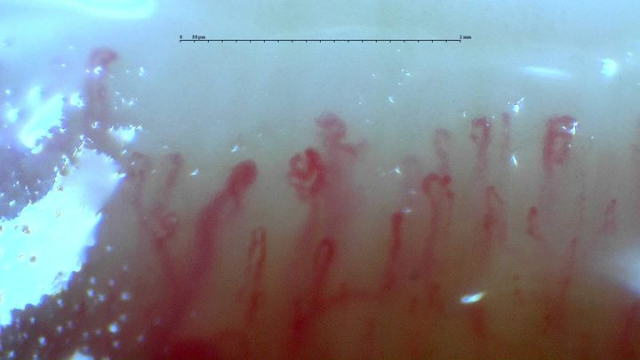 Irregular and branching forms in the anti-RNP-positive mixed connective tissue disease case. The source report describes a scleroderma-like pattern without an assignable Cutolo subtype.