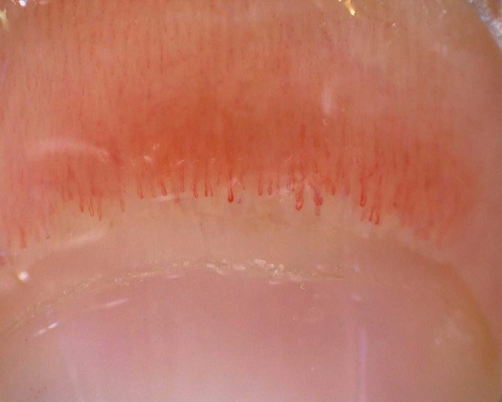 Initial nailfold overview in the juvenile anti-NXP2 longitudinal case. Compare the follow-up and the documented quantitative findings in the complete case.
