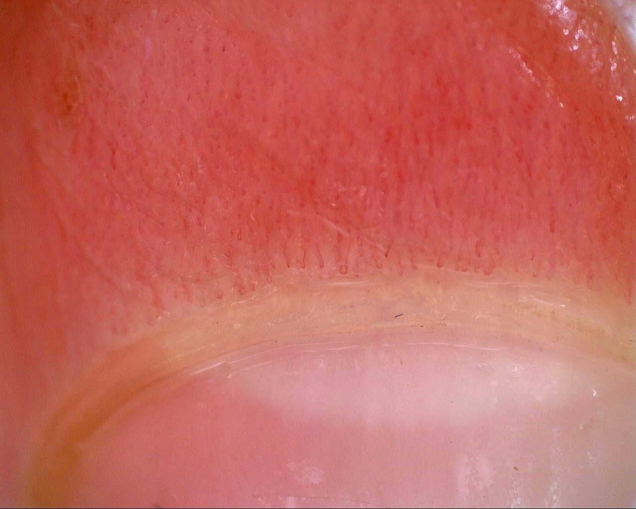 Initial nailfold overview from the longitudinal mixed connective tissue disease case. Use the serial studies to assess change in morphology and density.