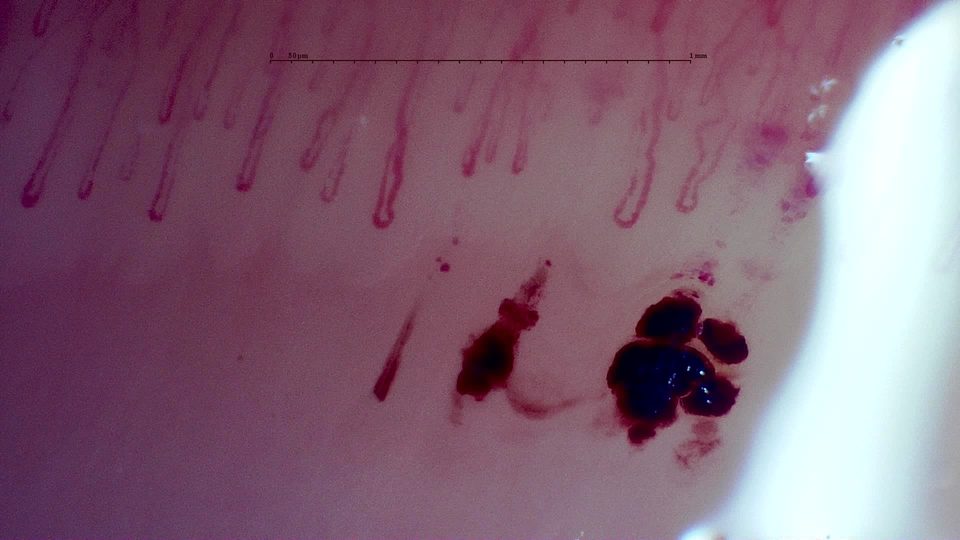 Preview image for MPO-ANCA Vasculitis with Rapidly Progressive Glomerulonephritis