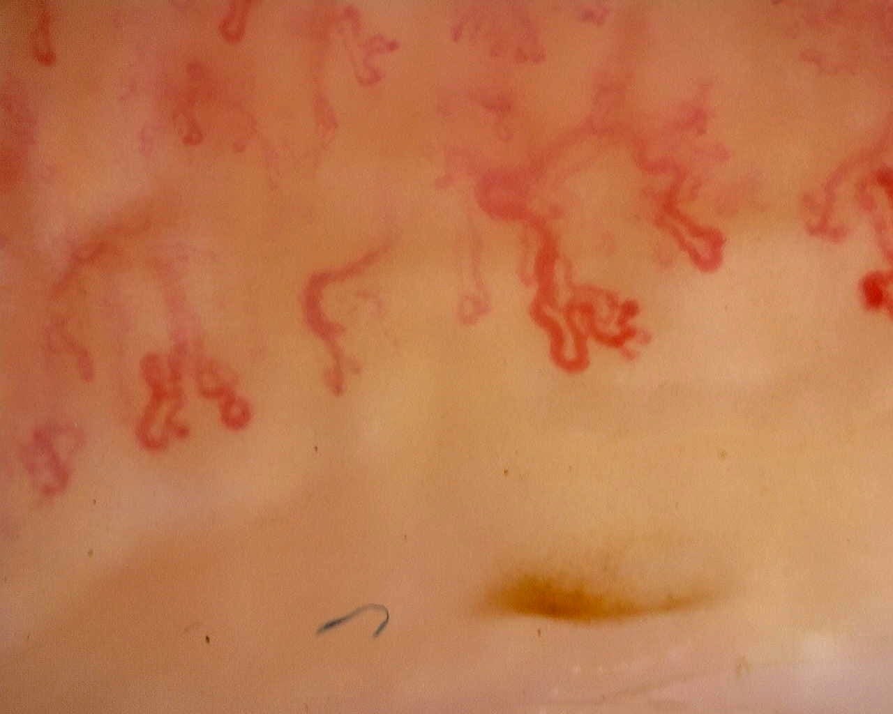 Severe capillary loss and neoangiogenesis