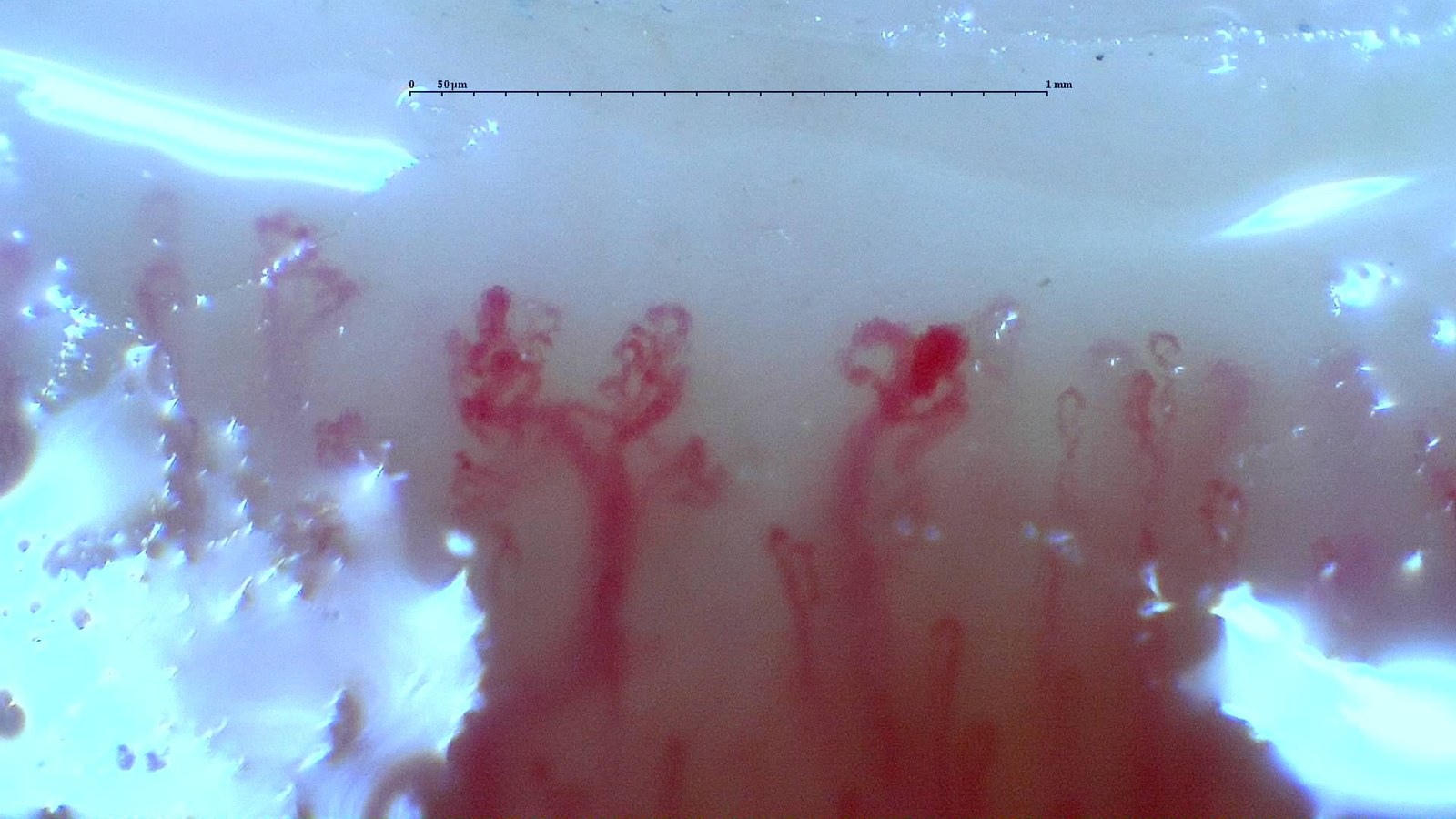 Arborizing and enlarged capillaries in a documented anti-RNP-positive MCTD case