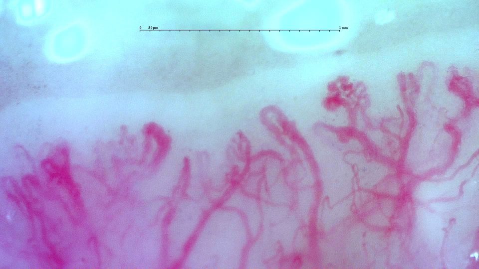 Preview image for Anti-TIF1γ Dermatomyositis with Scleroderma-Like Pattern