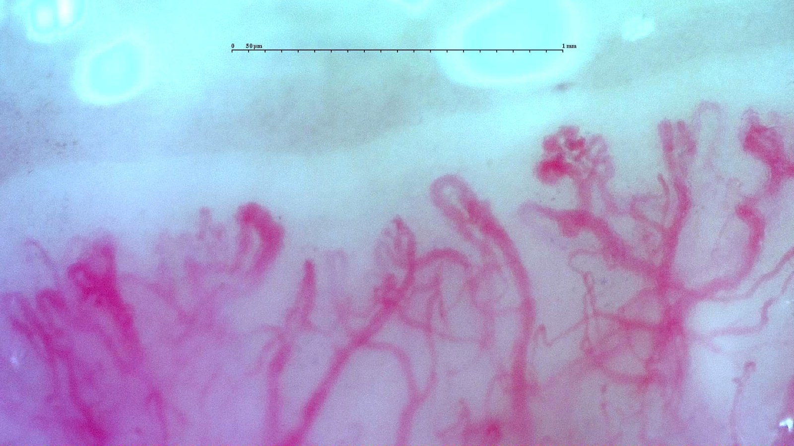 Scleroderma-like pattern in anti-TIF1gamma dermatomyositis