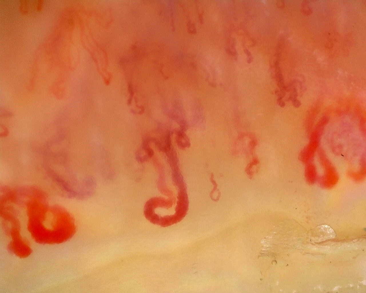 Late pattern with avascular areas and architectural disorganization
