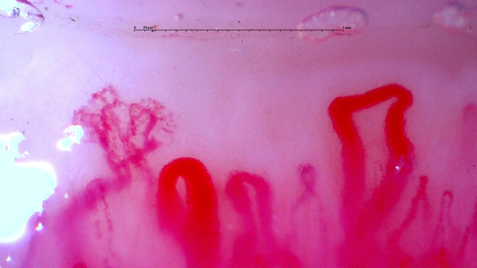Hemorrhages and active microangiopathy in a case of anti-NXP2 dermatomyositis from the capillaroscopy library