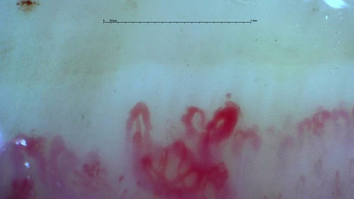 Irregular enlarged loops in the anti-U3 RNP case. Although giants remain present, the final report classifies the overall microangiopathy as late.