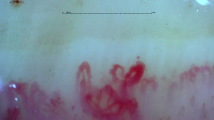 Irregular enlarged loops in the anti-U3 RNP case. Although giants remain present, the final report classifies the overall microangiopathy as late.