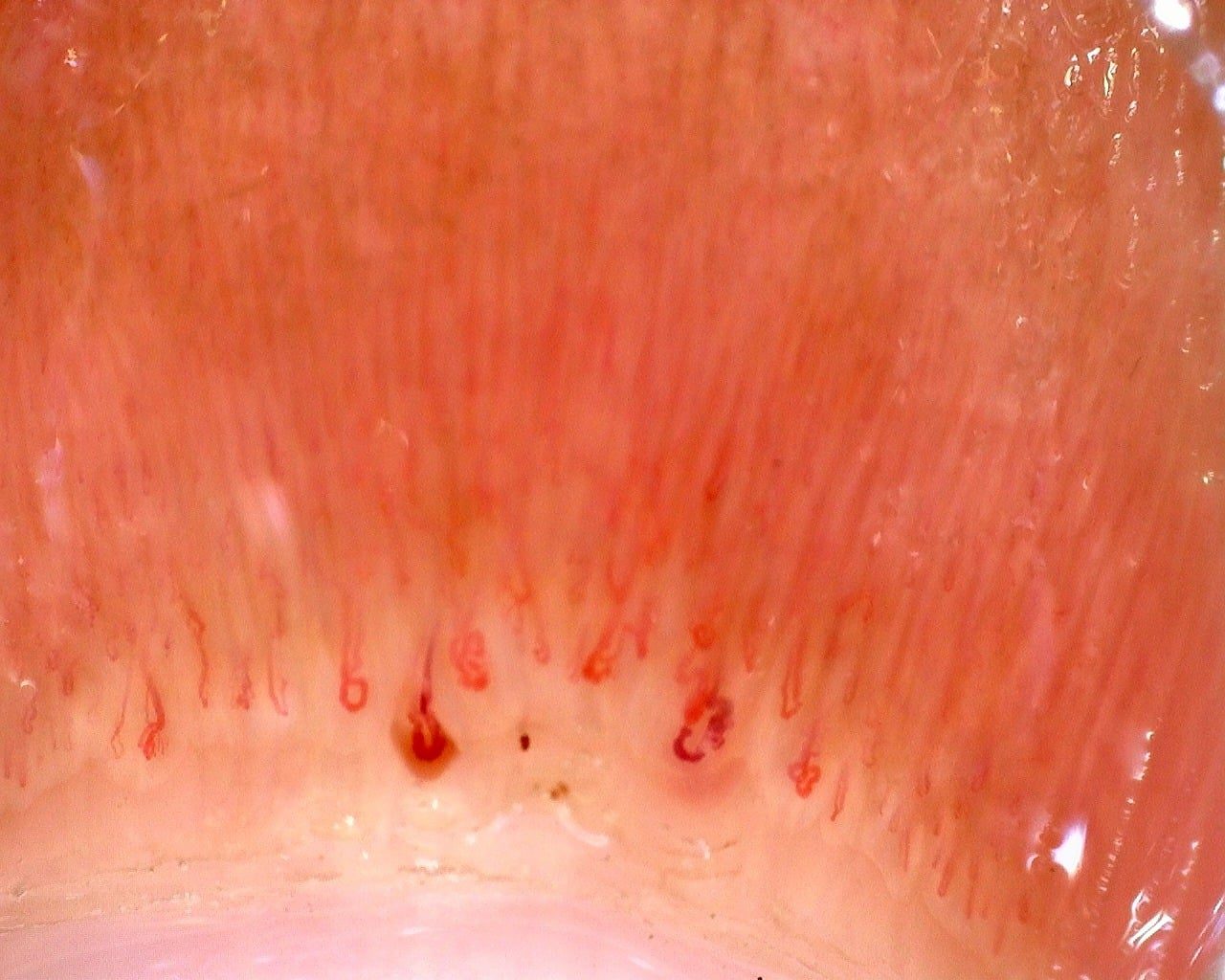 Severe microangiopathy in a patient with juvenile dermatomyositis