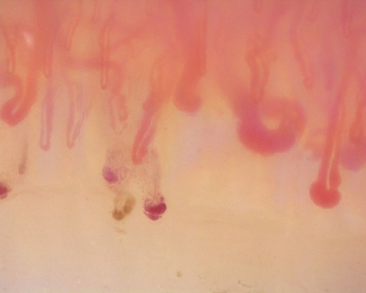 Enlarged loops and dark hemorrhagic deposits in the anti-Scl-70-positive active-pattern case. The source report notes no avascular areas in the study.