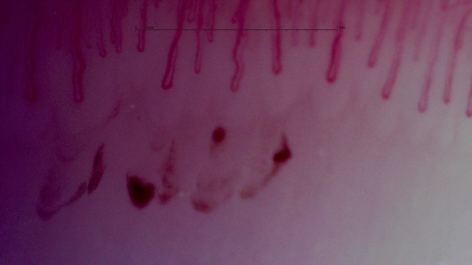 Hemorrhagic spots beneath the capillary row in the right little finger at baseline in the same MPO-positive AAV case