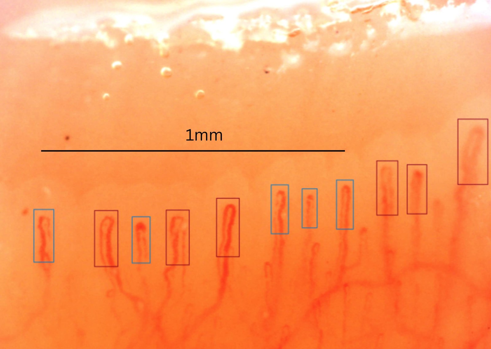 Example of classical semi-quantitative counting in capillaroscopy