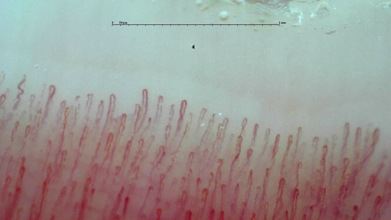 Morphological example of capillaroscopy with preserved architecture and mild variants