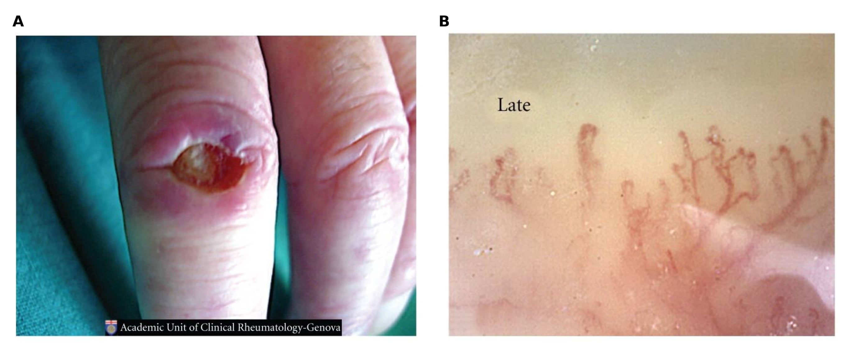 Digital ulcer and late capillaroscopy pattern