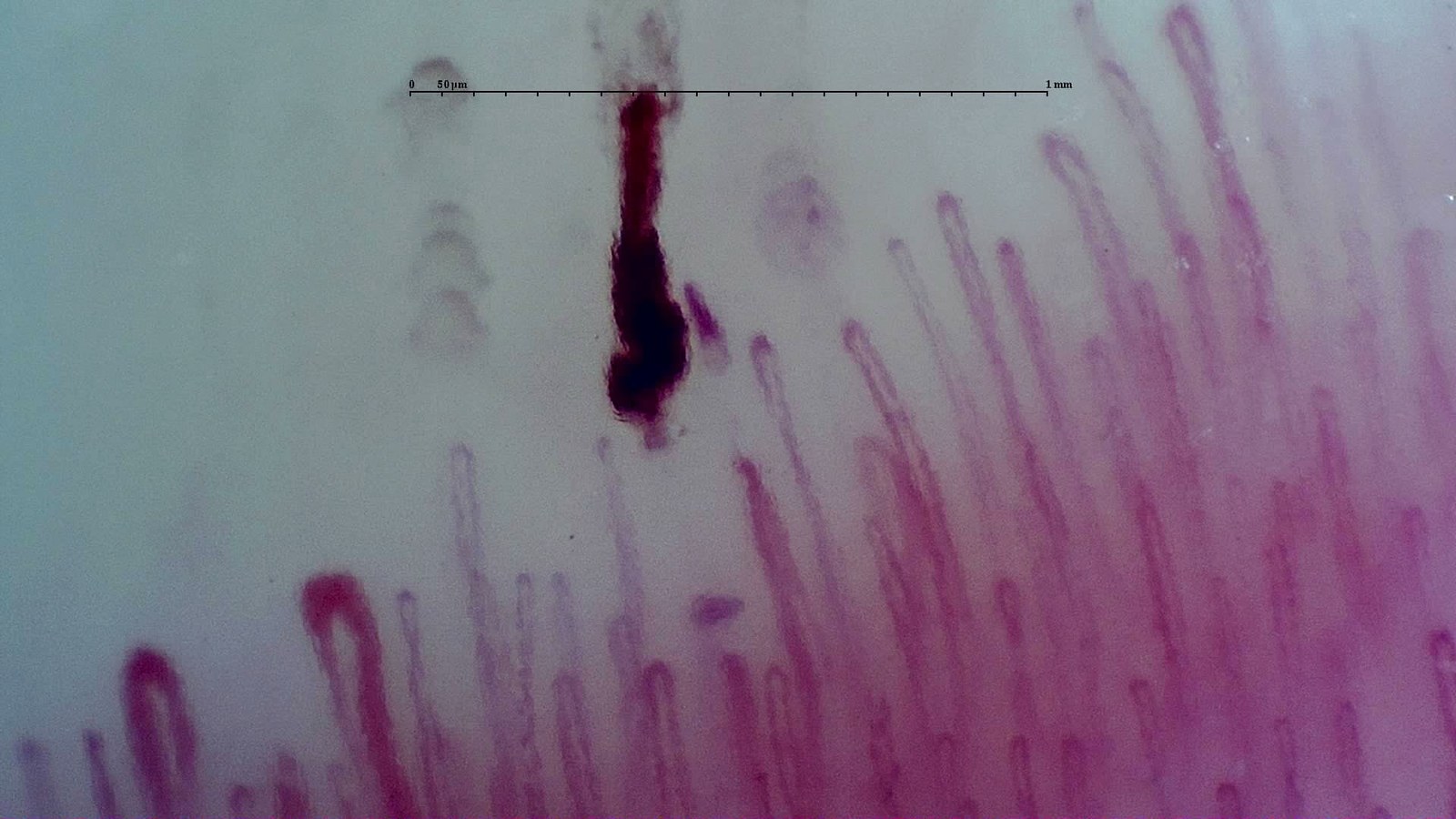 Giant capillaries and hemorrhages