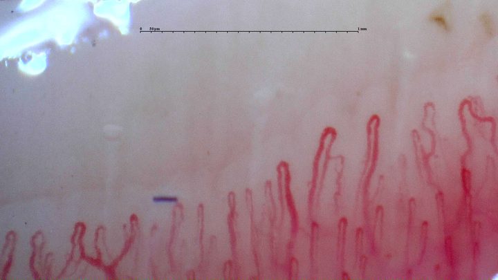 Elongated capillaries with small accessory loops, mainly on the right. A blue surface fragment is visible above the row.