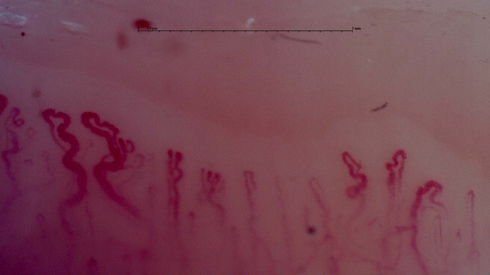 Broad folded capillaries on the left and finer loops on the right. A dark red microhemorrhage lies above the row.