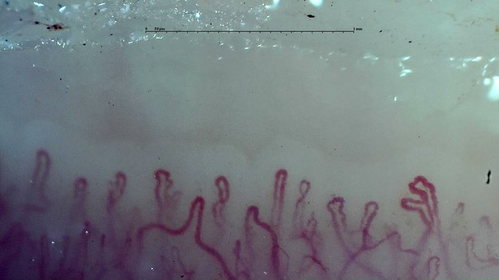 A capillary with several lateral loops near the right edge, beside capillaries with simpler rounded apices.