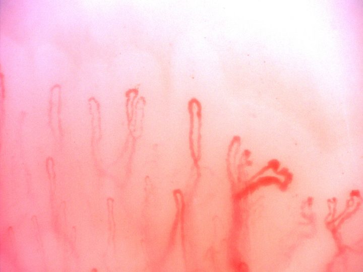 A capillary with two lateral loops at the lower right, with taller simple hairpin capillaries above it.