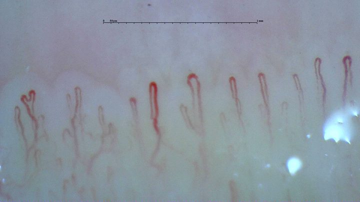 Mostly simple rounded hairpin capillaries, with one folded apex at the far left and mild curvature in some limbs.