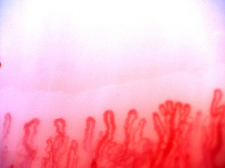 A branching capillary with several narrow apices on the right, beside thick tortuous loops on the left.