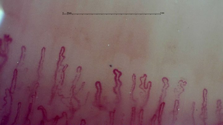 Capillaries with angular apices and accessory loops in the center and right. A broader loop is only partly visible at the left edge.