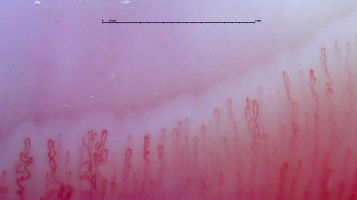 A fine branching capillary on the left, with slender hairpin loops and nearby crossed or curved capillaries.