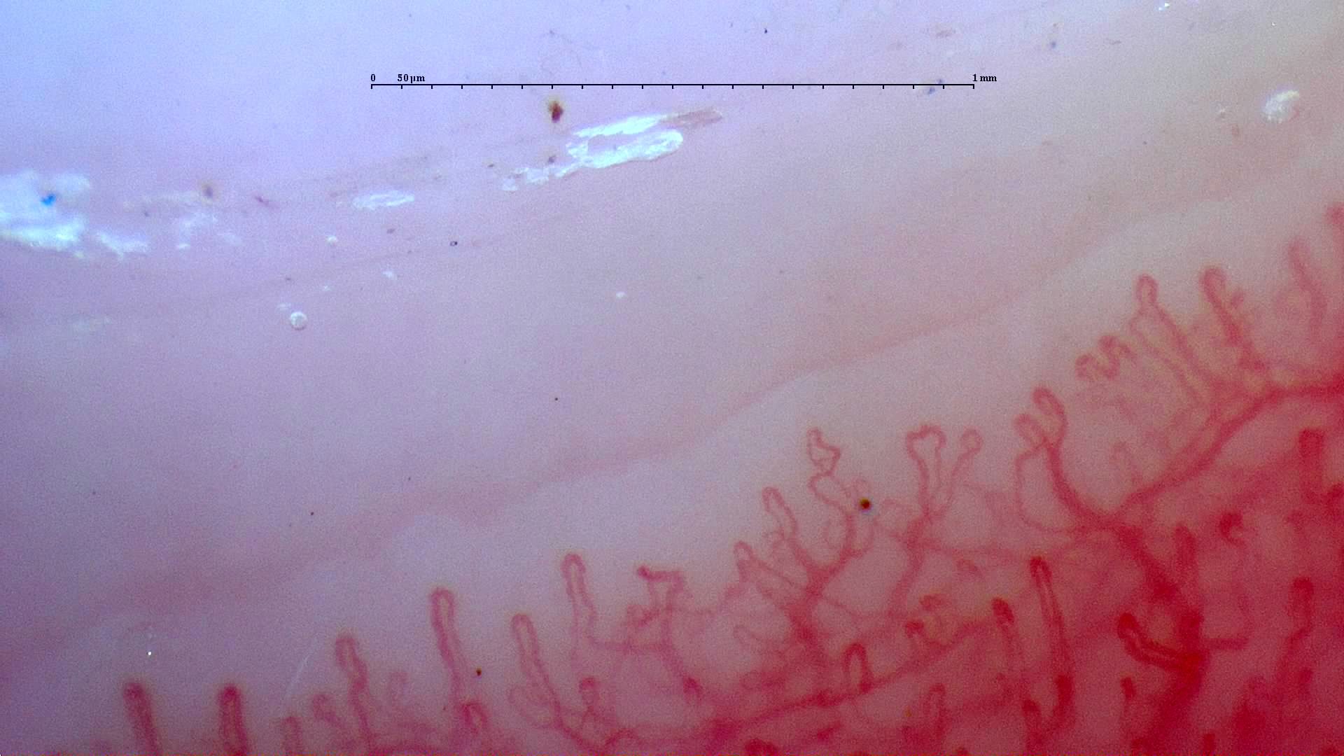 Capillaries with paired or accessory apices, especially on the right, mixed with simple hairpin loops.