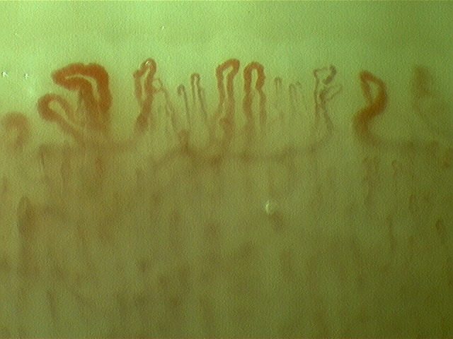 Giant-appearing capillaries with thick, folded loops on both sides, with fine hairpin capillaries in the center.
