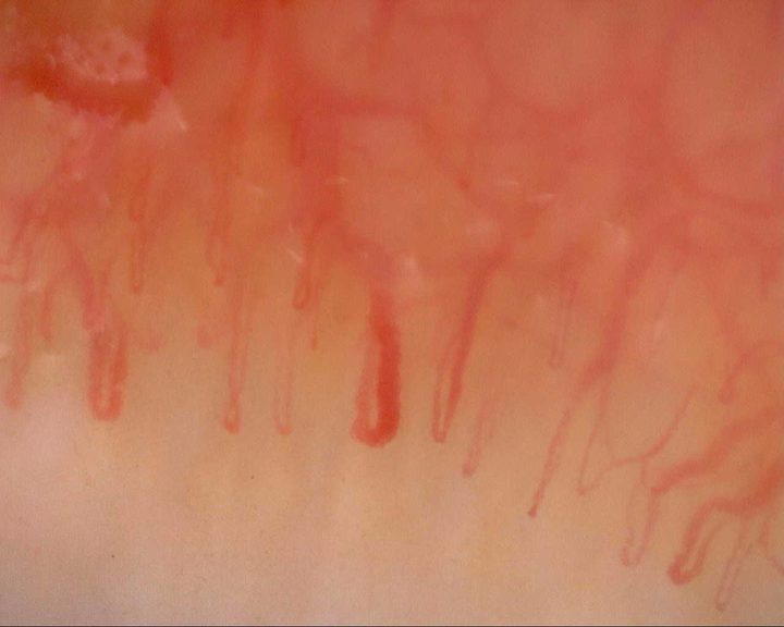 An enlarged central capillary with uneven limb thickness, beside narrow hairpin loops.