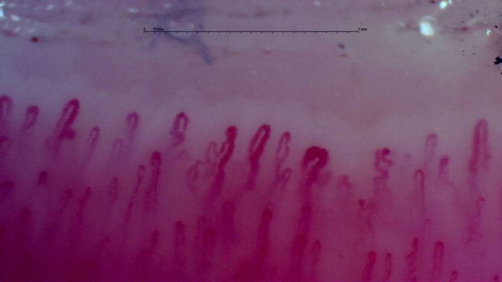 An enlarged rounded apex with a narrower limb right of center, surrounded by crossed and mildly tortuous capillaries.