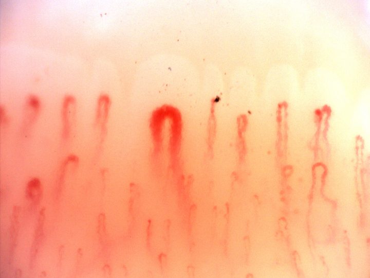 A central giant-appearing capillary with a thick rounded apex and broad limbs, surrounded by finer loops.