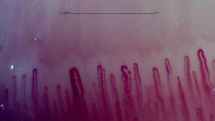 An enlarged hairpin capillary left of center, with narrower loops and a separate irregular apex nearby.