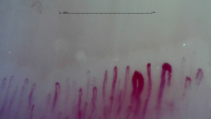 Two giant-appearing capillaries on the right, one oval and one with a rounded enlarged apex, beside fine hairpin loops.