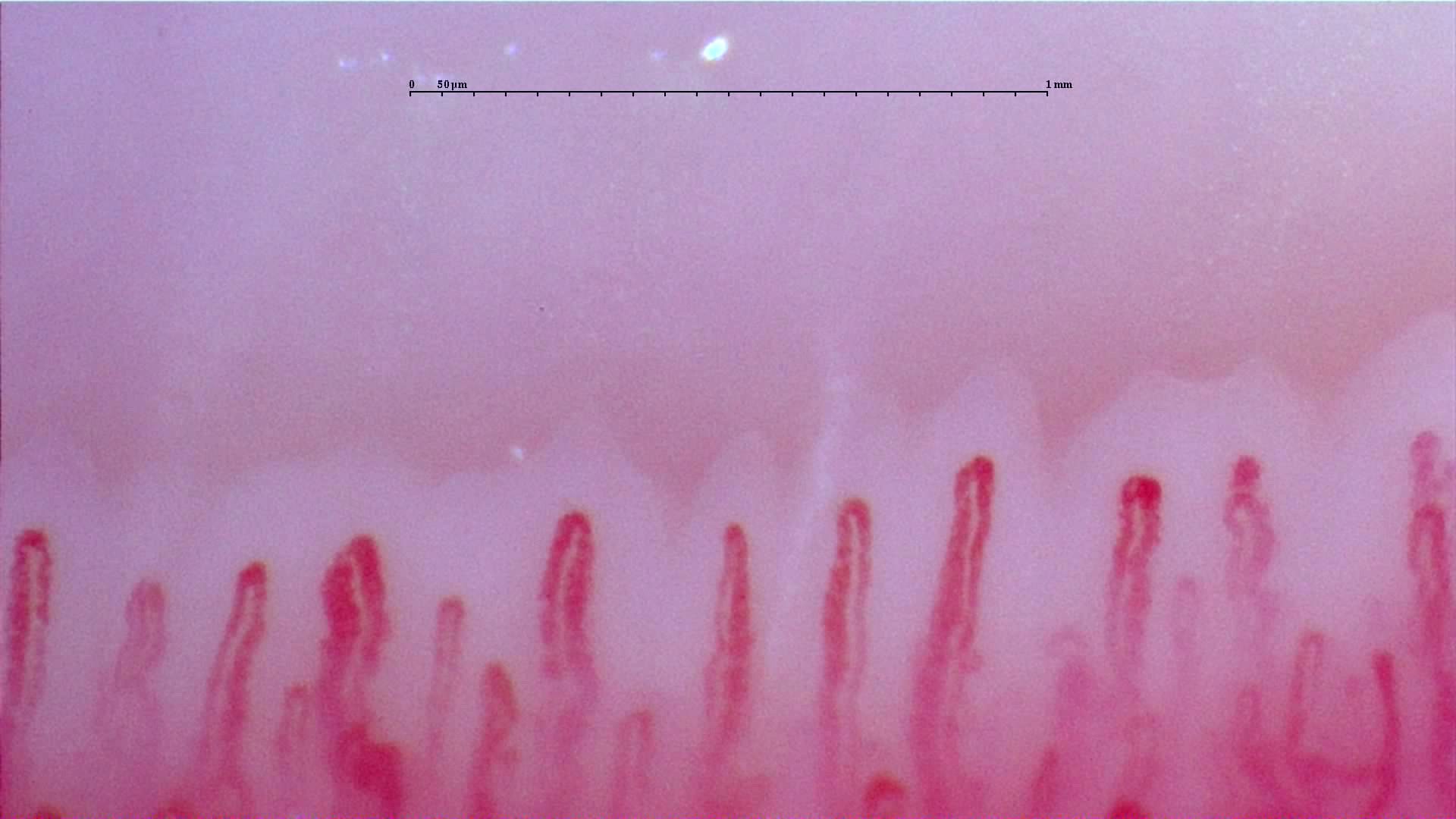 Enlarged hairpin capillaries, some with tortuous limbs, especially on the left.