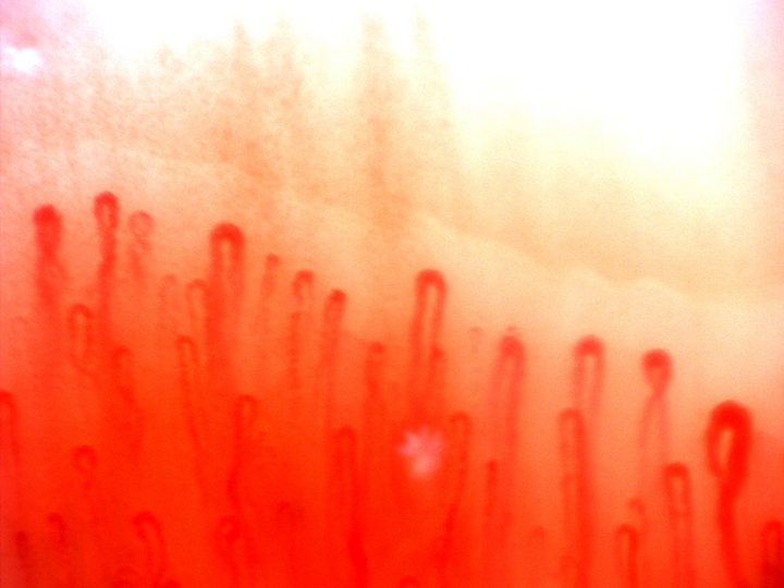 An oval giant-appearing capillary at the lower right, beside narrower hairpin loops with variable apical widths.