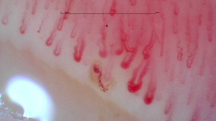 Several giant-appearing capillaries with thick rounded apices and curved limbs. A separate granular reddish-brown area lies near the central loops.
