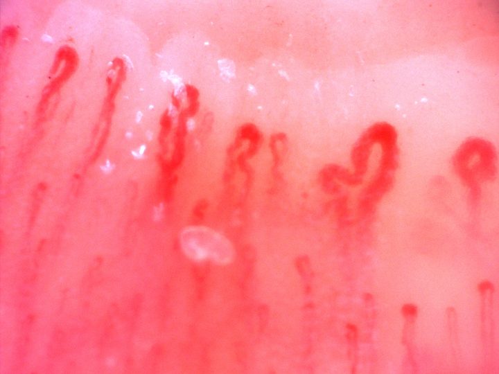 A hooked giant-appearing capillary right of center, beside smaller tortuous hairpin loops.