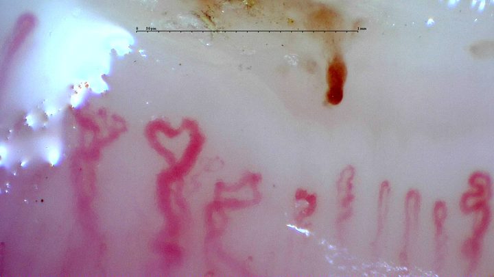 Broad, folded and branching-appearing capillaries with an elongated brown-red hemorrhage above them.