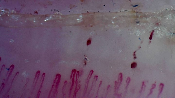 Enlarged hairpin capillaries and some tortuous loops. Several dark hemorrhagic deposits form short rows above them.