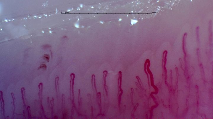A long tortuous capillary on the right, beside straighter loops. Several small hemorrhagic deposits lie above the left half.