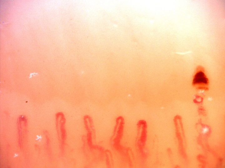Rounded capillary loops with some curved limbs and a dense dark hemorrhagic deposit above the right side.