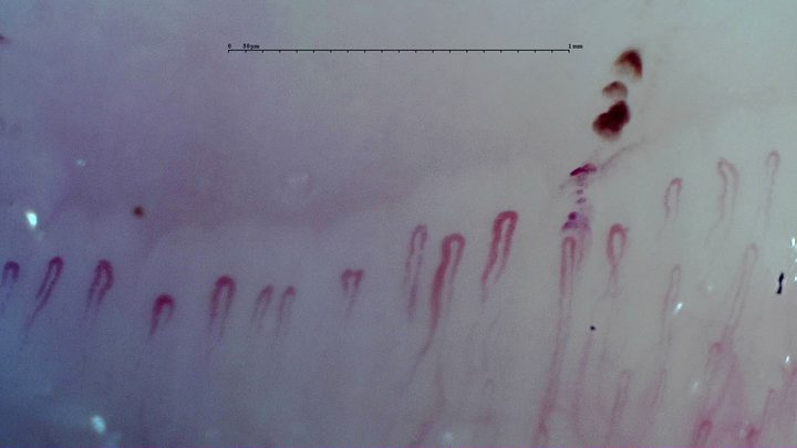 Mostly simple hairpin capillaries with rounded apices. Several dark hemorrhagic deposits lie above the center-right.