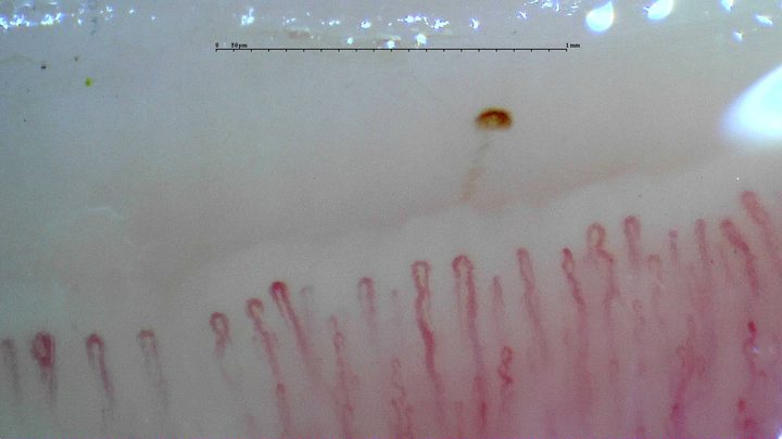 Fine hairpin capillaries with mild tortuosity and an isolated brown deposit compatible with a microhemorrhage above the row.