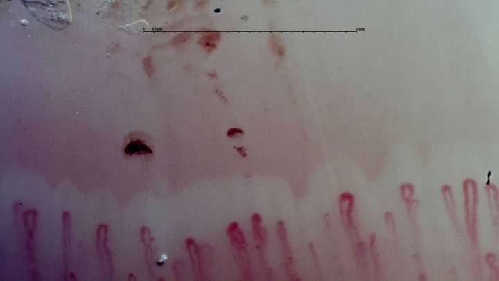 Capillaries with enlarged rounded apices and some folded loops. Several dark and pale red hemorrhagic deposits lie above them.