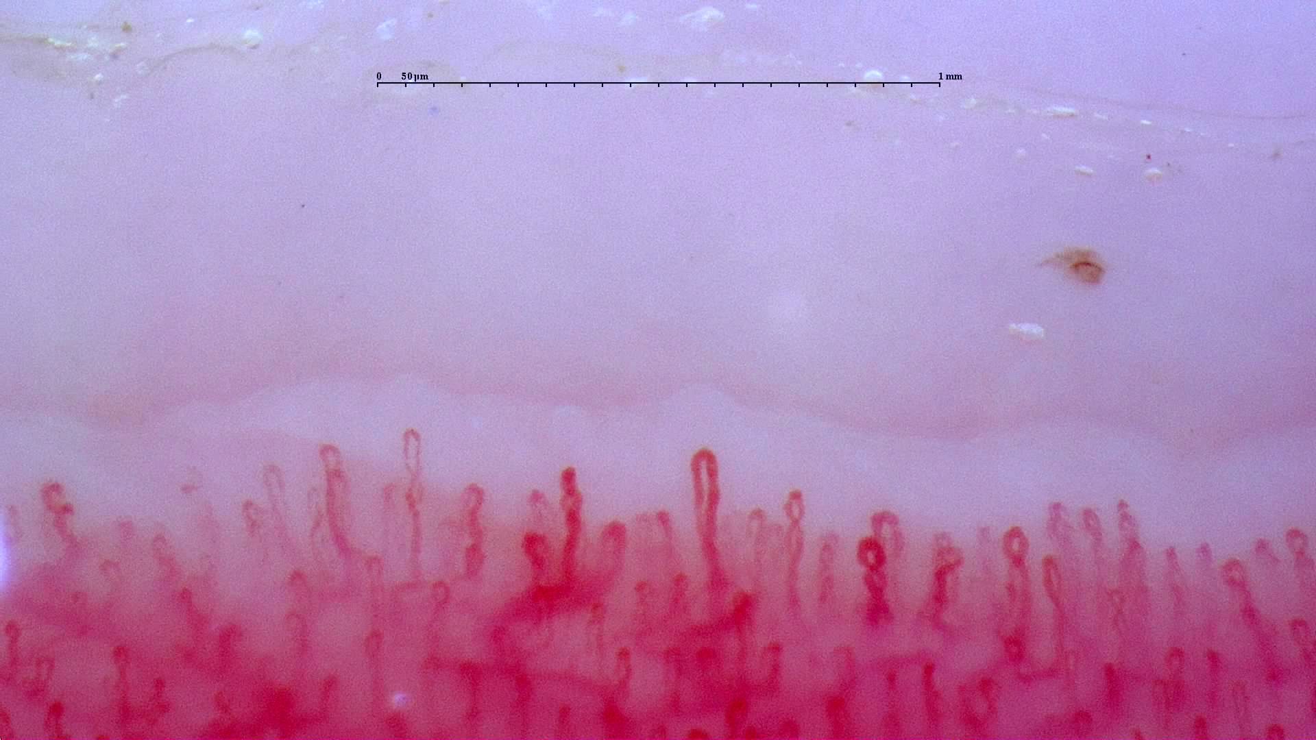 Short loops with occasional coiled apices and a visible deeper plexus. A small brown deposit above the right side may represent a microhemorrhage.
