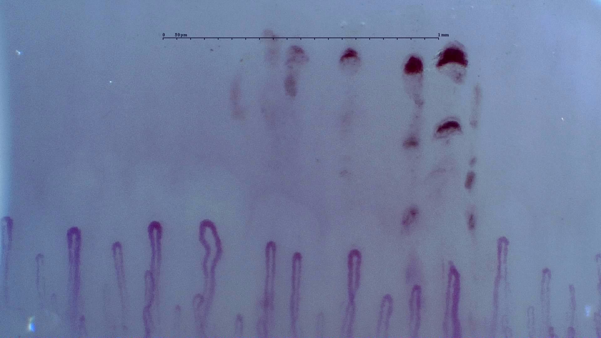 Slender rounded hairpin capillaries with mild bends. Several hemorrhagic deposits form short parallel rows above the right side.