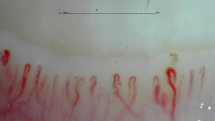 An enlarged tortuous capillary on the right, beside finer loops. A small brown deposit just above it may represent a microhemorrhage.